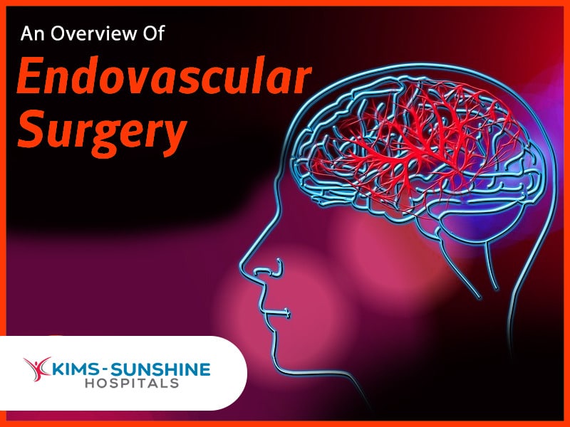 A Complete Overview Of Endovascular Surgery - Multispeciality Hospital