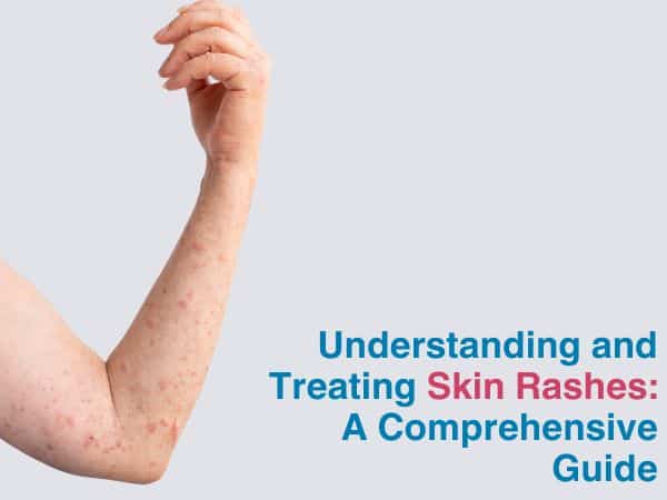 Home remedies for treating various types of skin rashes