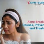 Acne Breakouts: Causes, Prevention, and Treatment