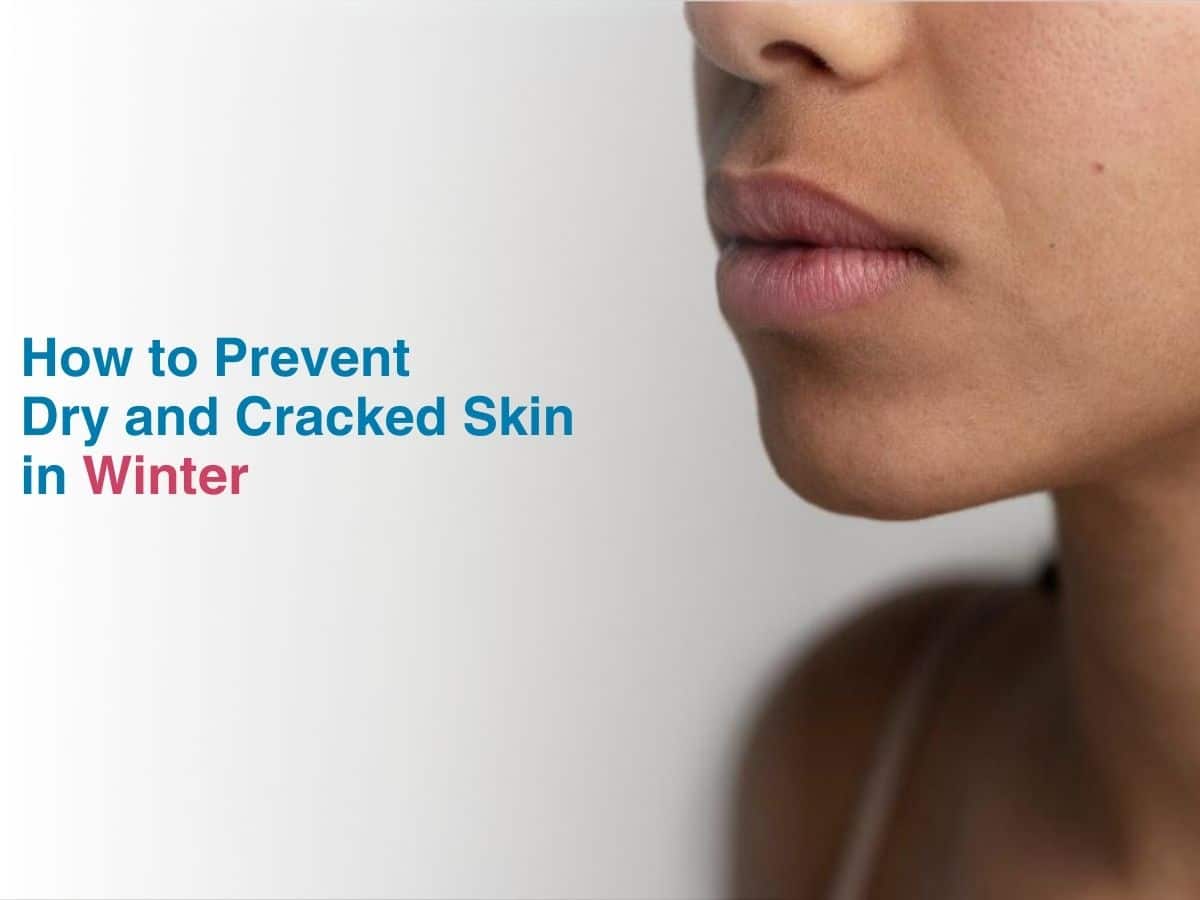 How to Prevent Dry and Cracked Skin in Winter