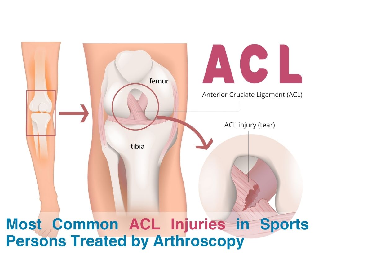 Common ACL Injuries in Athletes Treated Through Arthroscopy