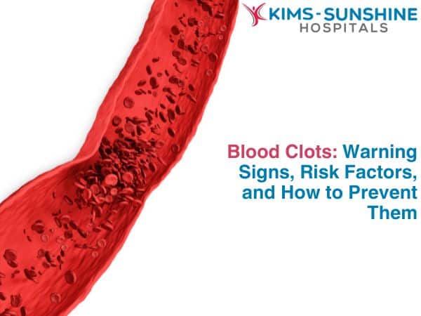 Blood Clots: Warning Signs, Risk Factors, and How to Prevent Them