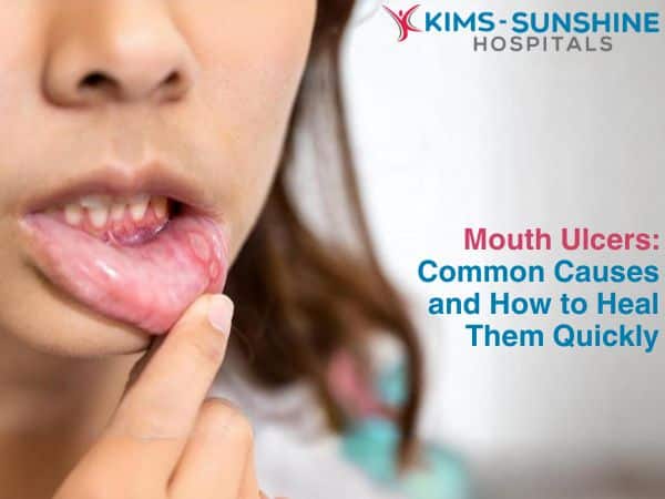 Mouth Ulcers: Common Causes and How to Heal Them Quickly