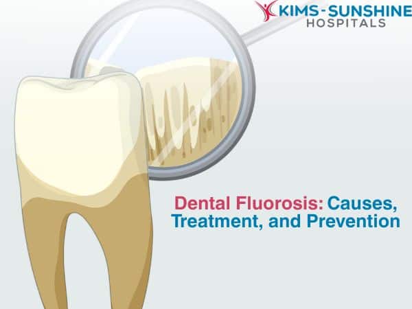June-Thumbnail -Dental Fluorosis_ Causes, Treatment, and Prevention