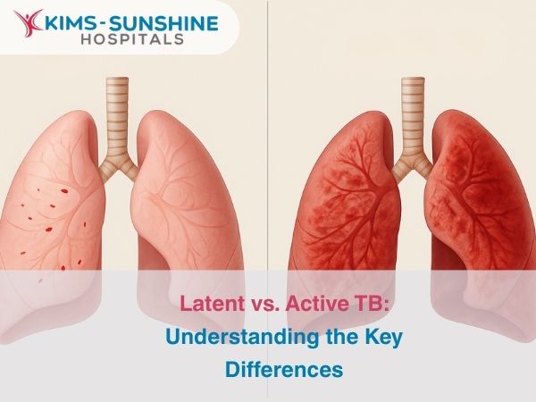 Latent vs. Active TB: Understanding the Key Differences